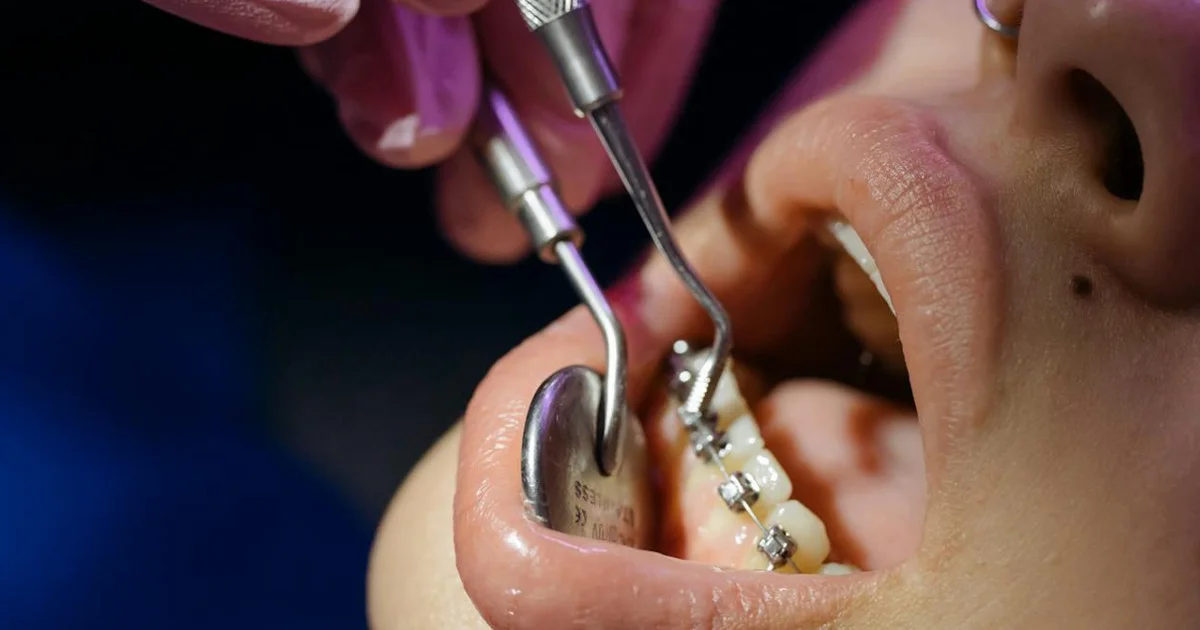 Les Appareils Dentaires à Sfax